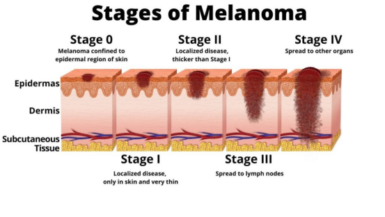 melanoma-checks-dermascope