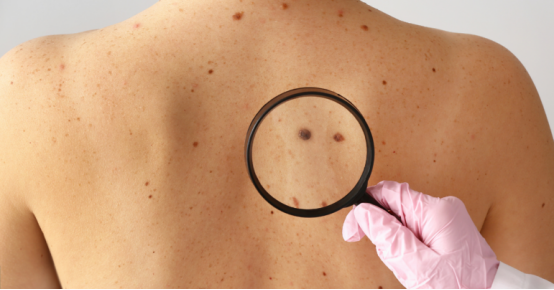 imoreme-dermoscope-in-cancer-detection
