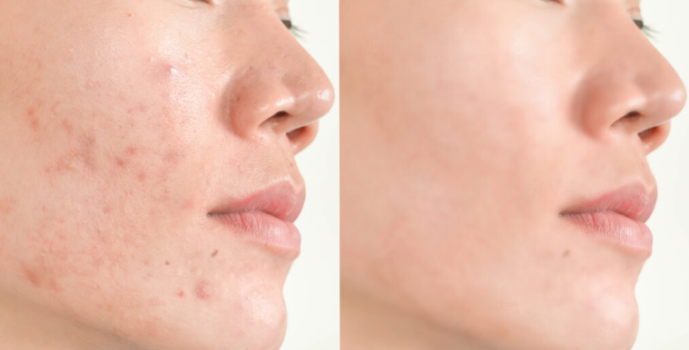 hydrodermabrasion-before-and-after