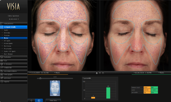 visia skin analysis
