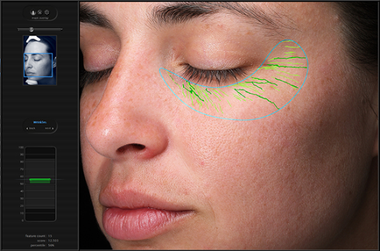 visia skin analysis