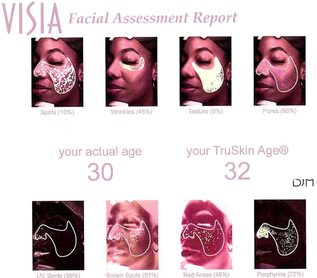 visia skin analysis machine