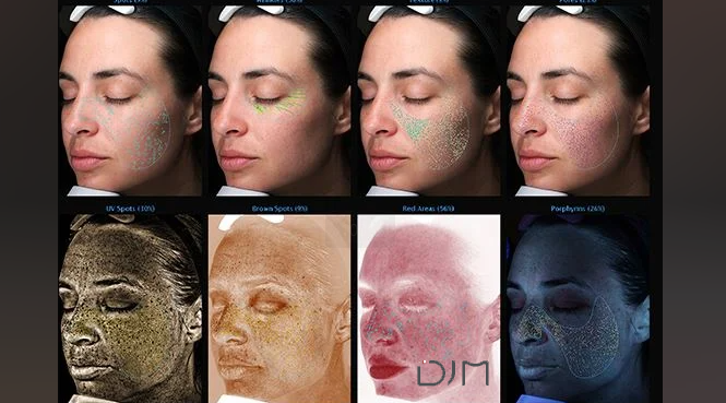Skin Analyzer,i MoreMe, DJM