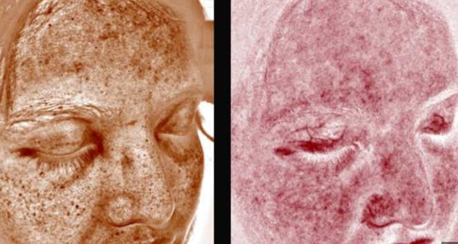 UV skin analysis