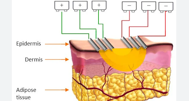 microcurrent facial device