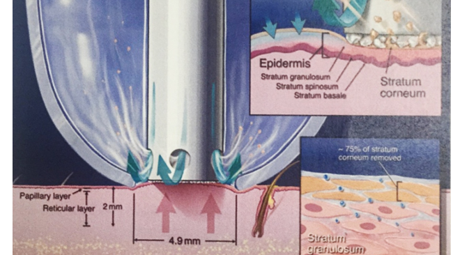 microdermabrasion